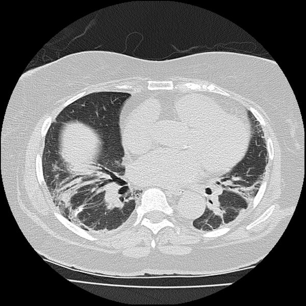 File:Acute interstitial pneumonitis (Radiopaedia 45404-49452 Axial lung window 55).jpg