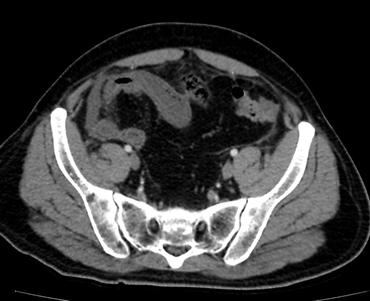 File:Acute mesenteric ischemia - superior mesenteric artery thrombosis (Radiopaedia 73947-84776 Axial C+ arterial phase 132).jpg
