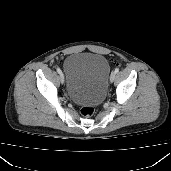 File:Acute pancreatitis (Radiopaedia 22572-22596 Axial C+ portal venous phase 62).jpg