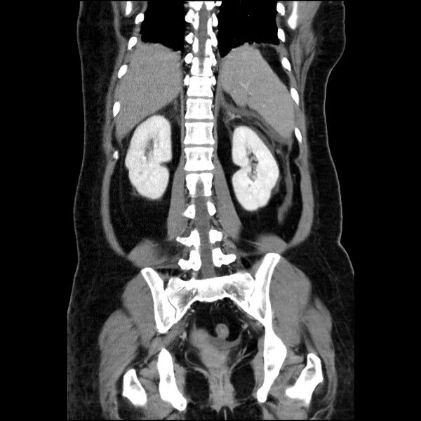 File:Acute pancreatitis (Radiopaedia 69236-79012 Coronal C+ portal venous phase 28).jpg