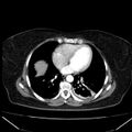 Acute pancreatitis - Balthazar C (Radiopaedia 26569-26714 Axial C+ arterial phase 3).jpg