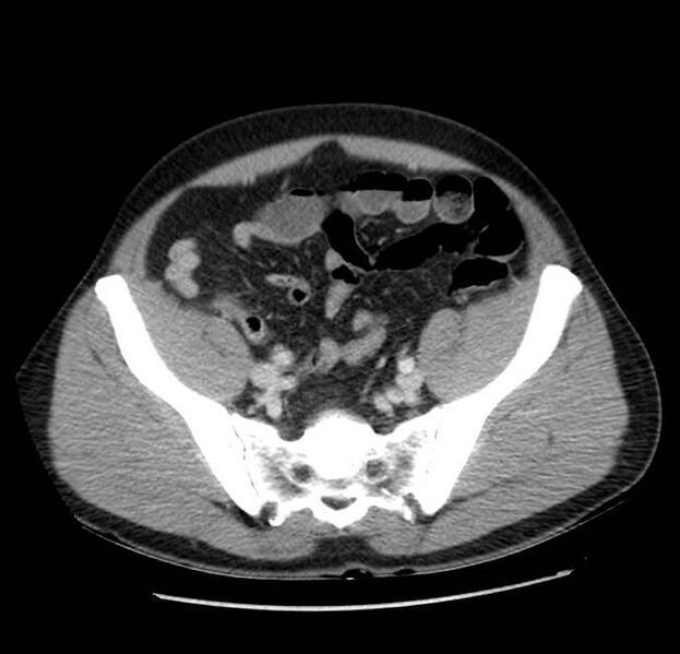 File:Acute pancreatitis - Balthazar E (Radiopaedia 23080-23110 Axial C+ portal venous phase 57).jpg