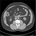 Acute pancreatitis - mild (Radiopaedia 27796-28033 Axial non-contrast 28).jpg