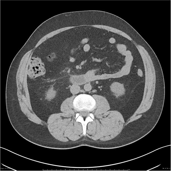 File:Acute pancreatitis - mild (Radiopaedia 27796-28033 Axial non-contrast 28).jpg
