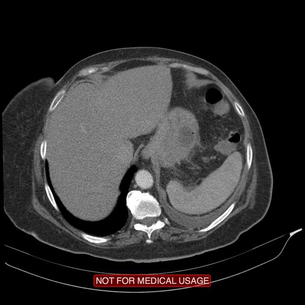 File:Acute pancreatitis with infected necrosis (Radiopaedia 26454-26585 Axial C+ arterial phase 3).jpg