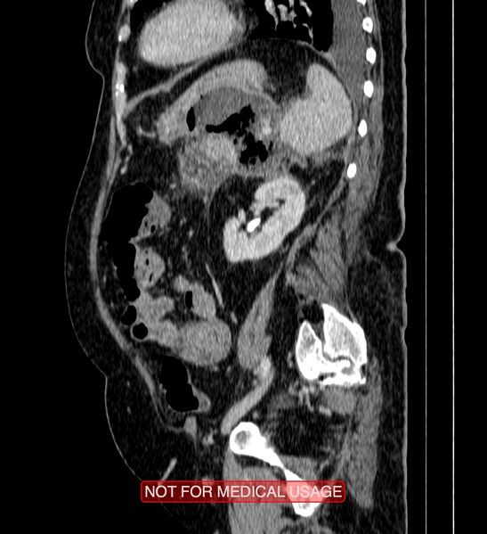 File:Acute pancreatitis with infected necrosis (Radiopaedia 26454-26585 Sagittal C+ portal venous phase 1).jpg