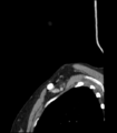 Acute parotitis (Radiopaedia 27425-27619 Sagittal C+ portal venous phase 2).png