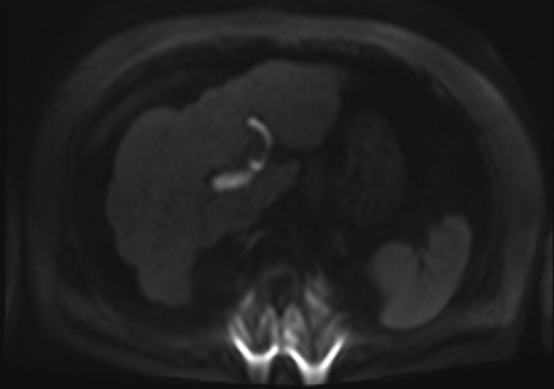 File:Acute portal vein thrombosis (Radiopaedia 73198-83925 Axial DWI 73).jpg