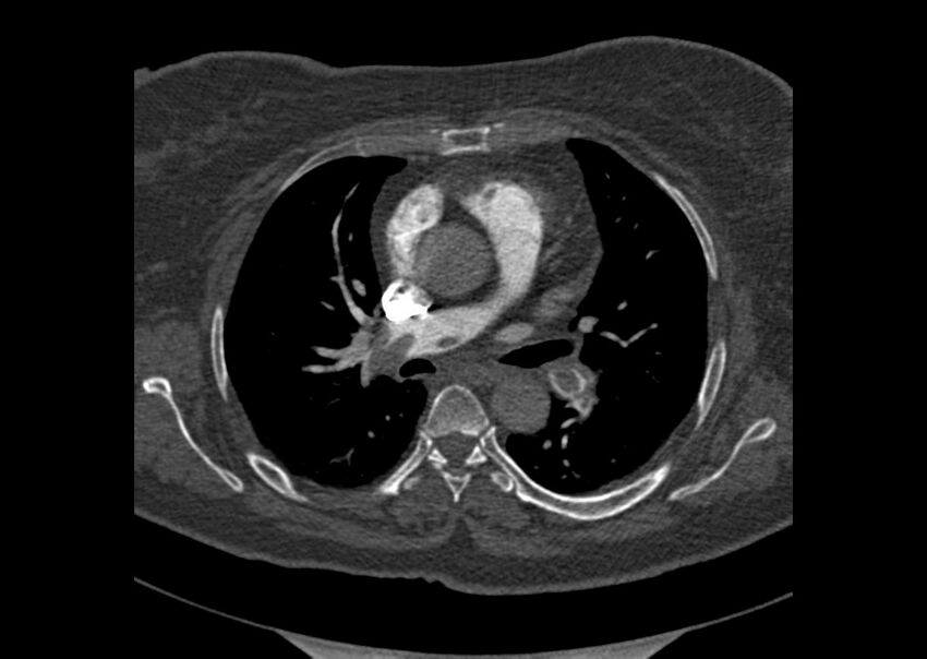 Acute pulmonary embolism (Radiopaedia 29938-30466 Axial C+ CTPA 64).jpg