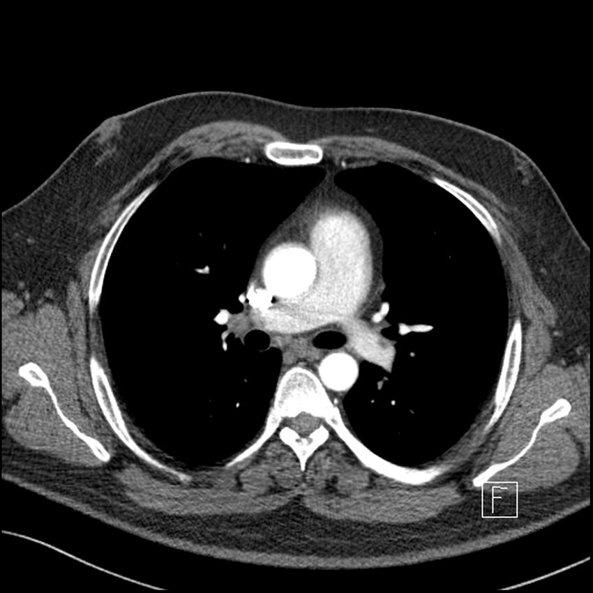 Acute pulmonary embolism with pulmonary infarct (Radiopaedia 73062-83768 Axial C+ CTPA 32).jpg