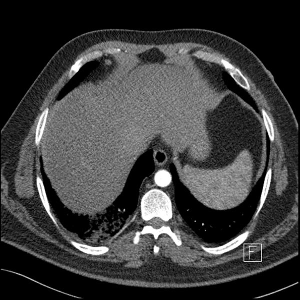 File:Acute pulmonary embolism with pulmonary infarct (Radiopaedia 73062-83768 Axial C+ CTPA 64).jpg