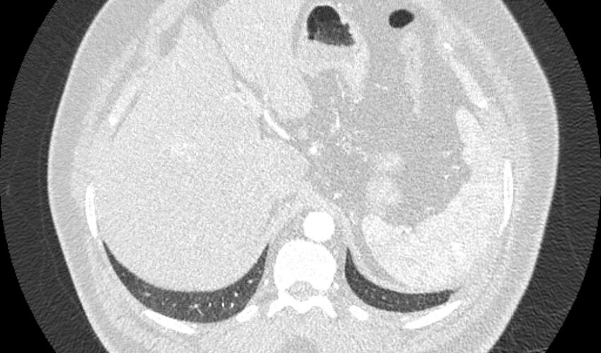 Acute pulmonary embolism with pulmonary infarcts (Radiopaedia 77688-89908 Axial lung window 133).jpg