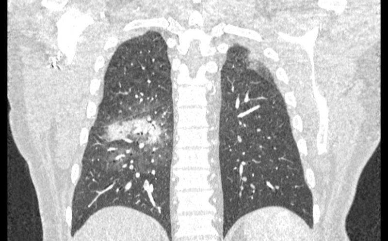 File:Acute pulmonary embolism with pulmonary infarcts (Radiopaedia 77688-89908 Coronal lung window 77).jpg