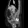 Acute pyelonephritis (Radiopaedia 25657-25837 Sagittal renal parenchymal phase 35).jpg