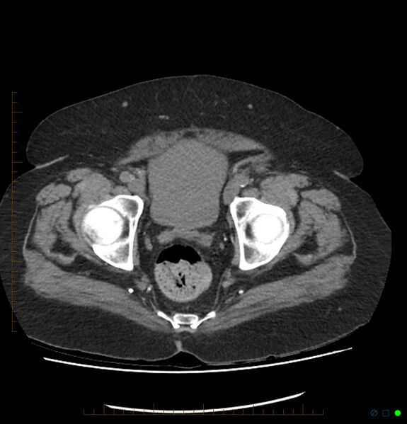 File:Acute renal failure post IV contrast injection- CT findings (Radiopaedia 47815-52557 Axial non-contrast 74).jpg