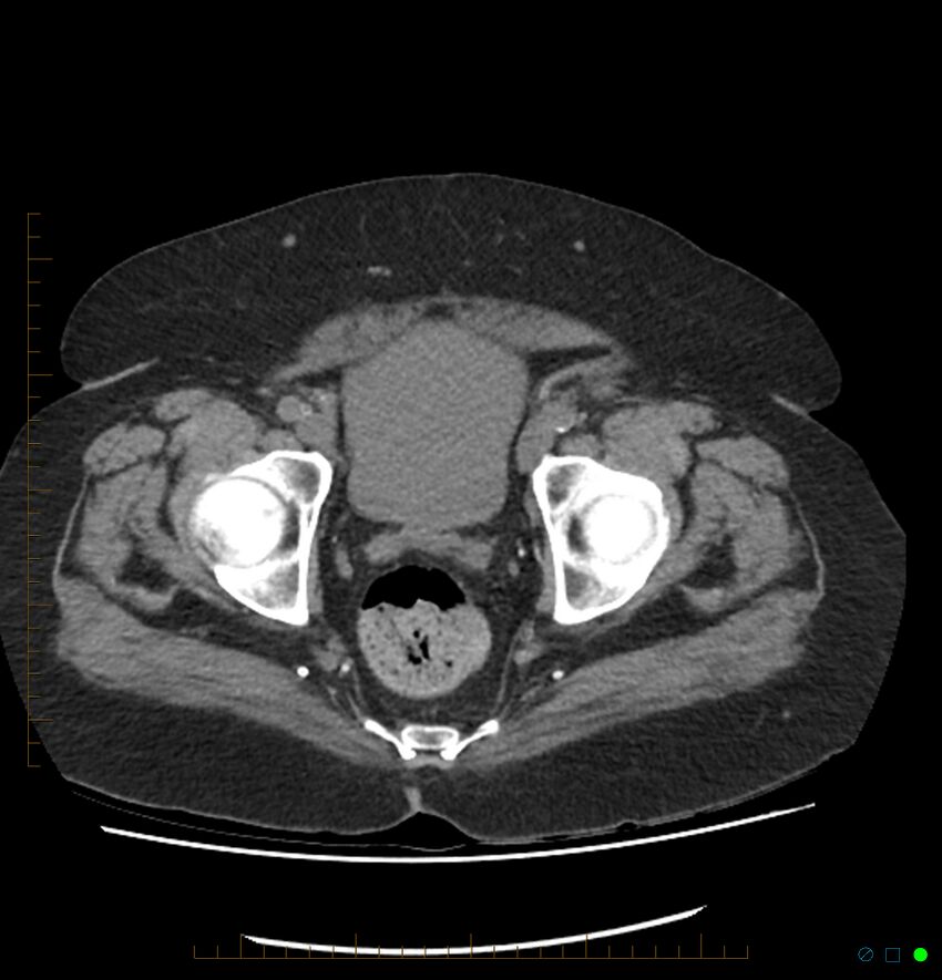 Acute renal failure post IV contrast injection- CT findings (Radiopaedia 47815-52557 Axial non-contrast 74).jpg