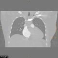 Acute reversible pulmonary hypertension and right heart failure from cocaine toxicity (Radiopaedia 49394-54517 Coronal C+ CTPA 16).jpg