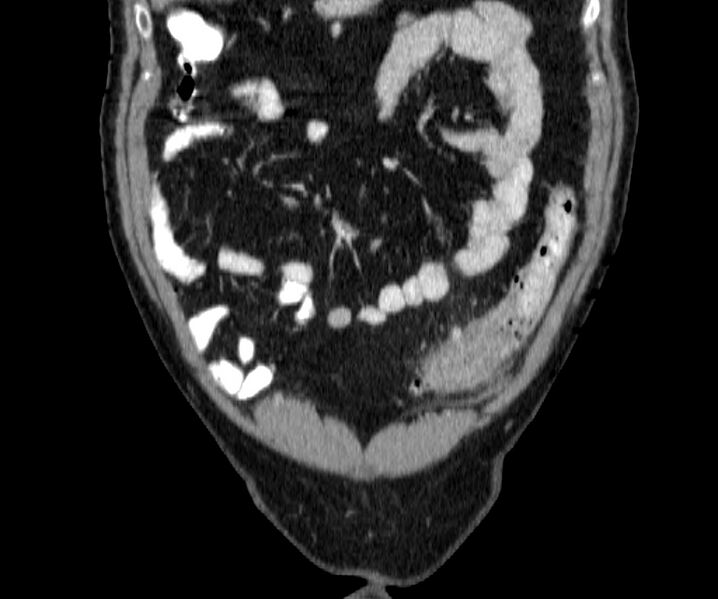 File:Acute sigmoid colon diverticulitis (Radiopaedia 55507-61976 Coronal C+ portal venous phase 22).jpg