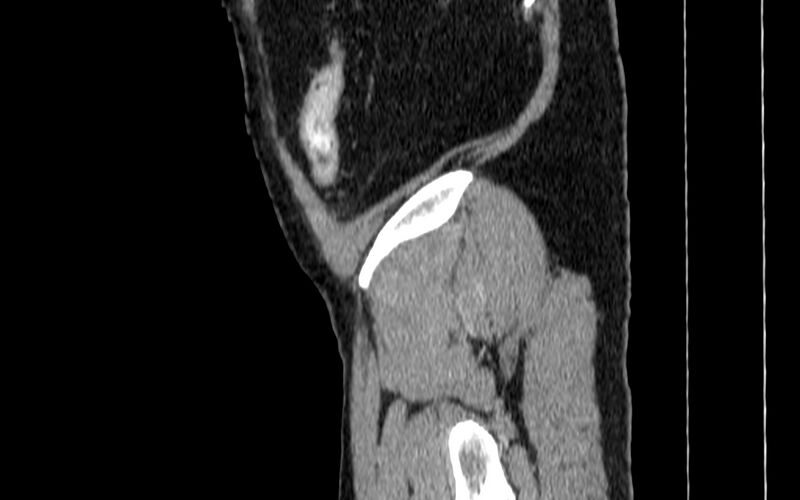 File:Acute sigmoid colon diverticulitis (Radiopaedia 55507-61976 Sagittal C+ portal venous phase 136).jpg