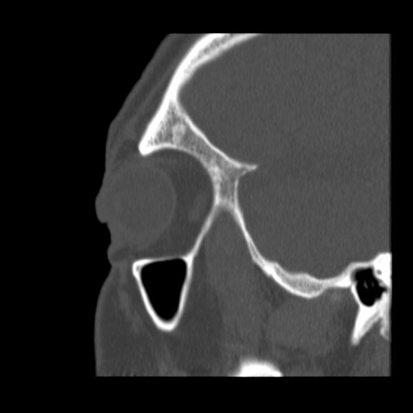 File:Acute sinusitis (Radiopaedia 23161-23215 Sagittal bone window 13).jpg