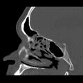 Acute sinusitis (Radiopaedia 23161-23215 Sagittal bone window 38).jpg