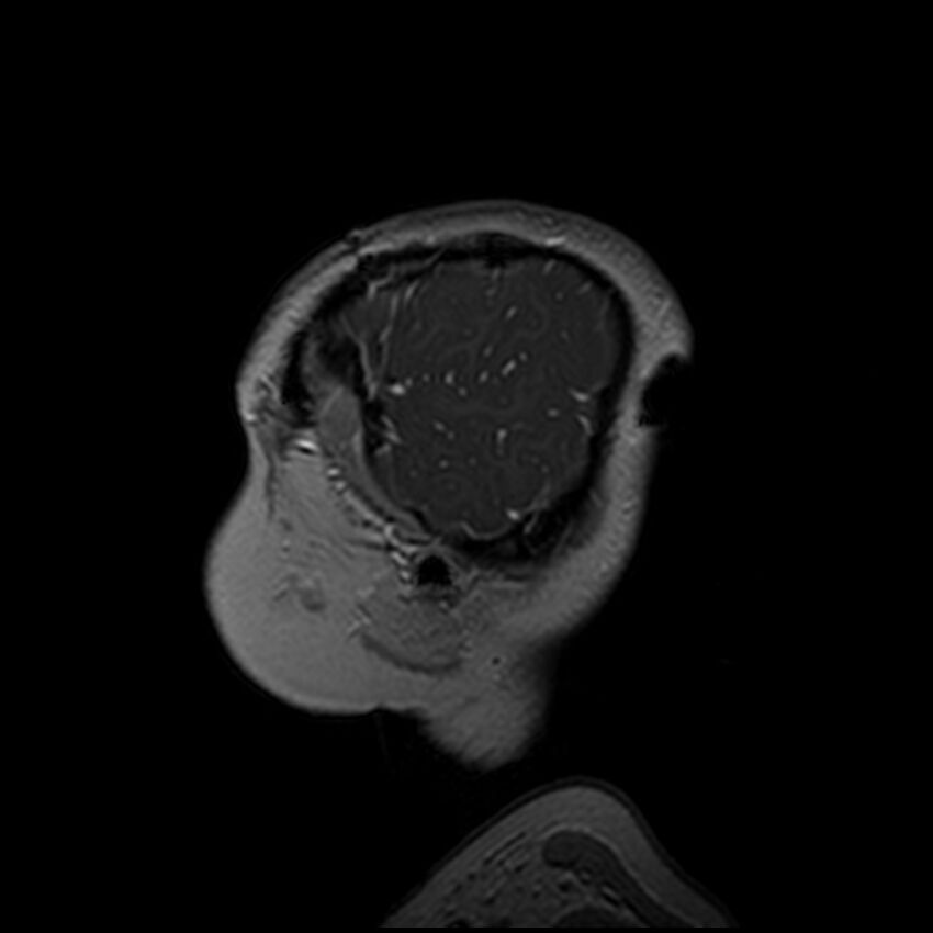 Adamantinomatous craniopharyngioma (Radiopaedia 77407-89529 H 111).jpg