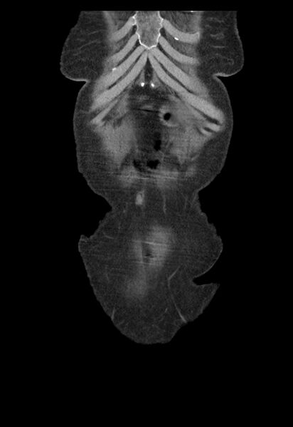 File:Adenocarcinoma of cecum (Radiopaedia 59222-66549 Coronal C+ portal venous phase 1).jpg