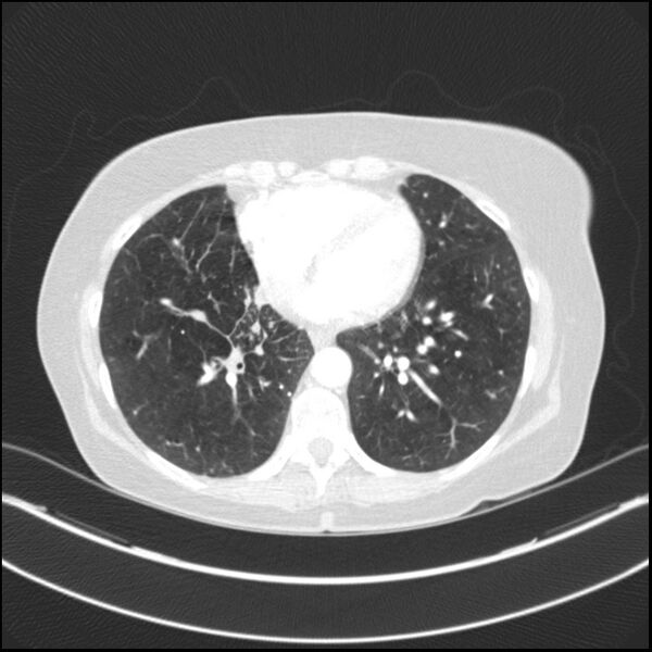 File:Adenocarcinoma of the lung (Radiopaedia 44205-47803 Axial lung window 62).jpg