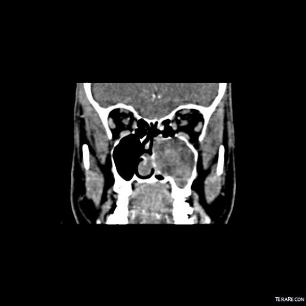 File:Adenoid cystic carcinoma involving paranasal sinus (Radiopaedia 16580-16283 Coronal C+ arterial phase 4).jpeg