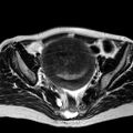 Adenomyoma of the uterus (huge) (Radiopaedia 9870-10438 Axial T2 24).jpg