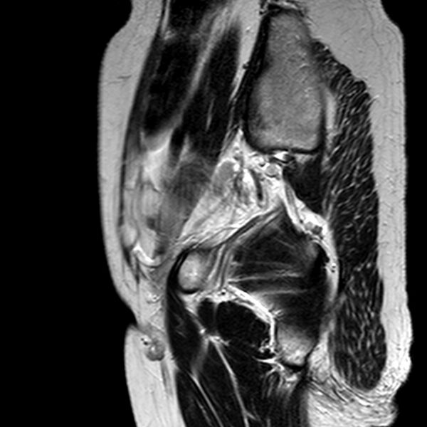 File:Adenomyoma of the uterus (huge) (Radiopaedia 9870-10438 Sagittal T2 22).jpg
