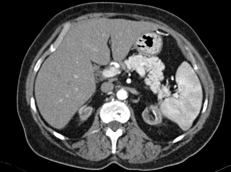 File:Adenomyomatosis of the gallbladder (Radiopaedia 12142-12483 Axial C+ arterial phase 3).jpg