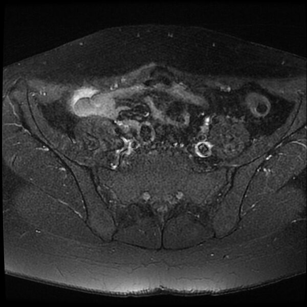 File:Adenomyosis-scar endometriosis (Radiopaedia 65863-75022 Axial T1 C+ fat sat 2).jpg