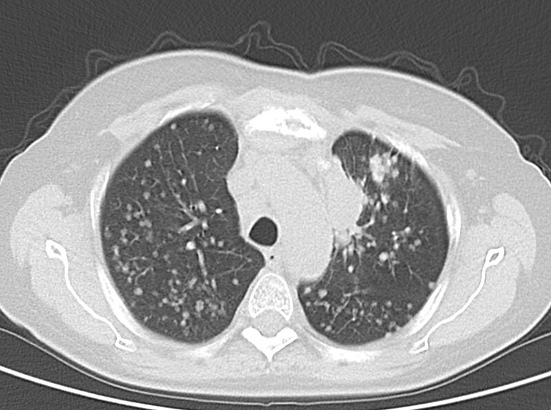 File:Adenosquamous lung carcinoma (Radiopaedia 22035-22030 lung window 23).jpg