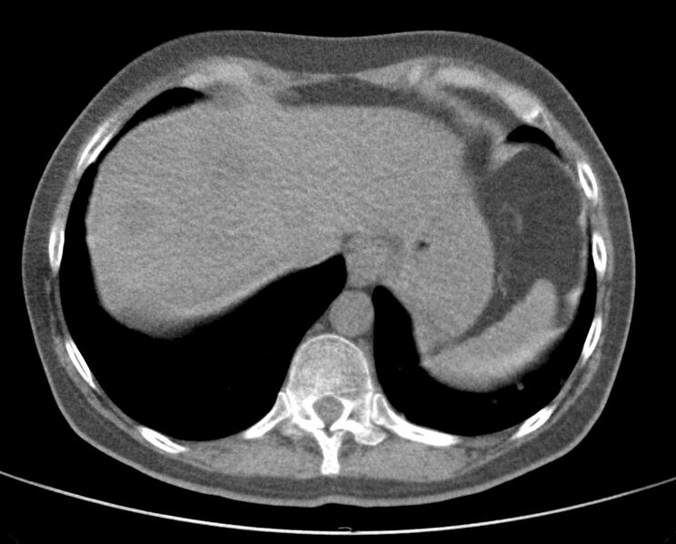 File:Adenosquamous lung carcinoma (Radiopaedia 22035-22030 non-contrast 51).jpg