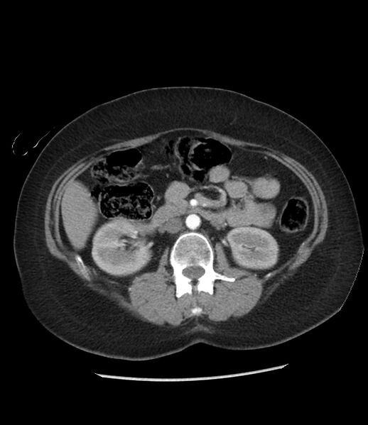 File:Adrenal cortical carcinoma with IVC invasion and thrombosis (Radiopaedia 34307-35597 Axial C+ arterial phase 40).jpg