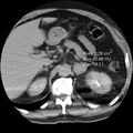 Adrenal hemangioma (Radiopaedia 11039-11445 Axial ROIs HU 4).jpg