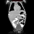 Adrenal hemorrhage (Radiopaedia 9390-10077 Coronal C+ portal venous phase 1).jpg