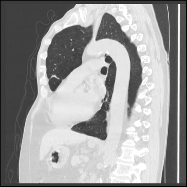 File:Alpha-1-antitrypsin deficiency (Radiopaedia 40993-43722 Sagittal lung window 118).jpg
