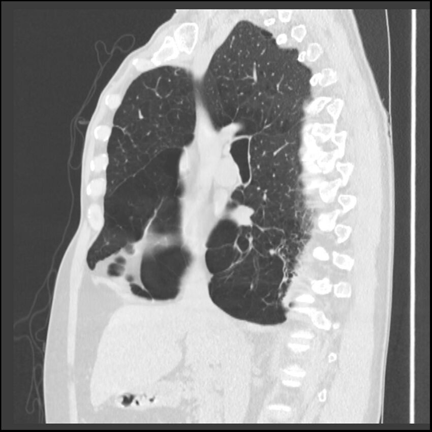 Alpha-1-antitrypsin deficiency (Radiopaedia 40993-43722 Sagittal lung window 154).jpg