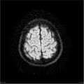 Amnestic syndrome secondary to hypoxic brain injury (Radiopaedia 24743-25004 DWI 27).jpg