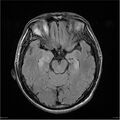 Amnestic syndrome secondary to hypoxic brain injury (Radiopaedia 24743-25004 FLAIR 8).jpg