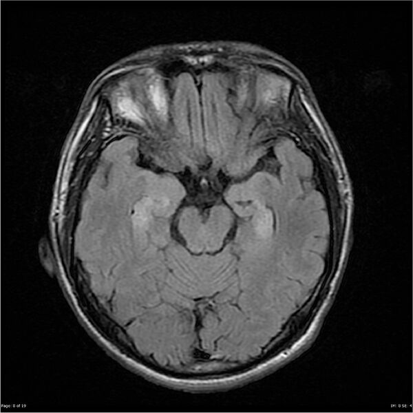File:Amnestic syndrome secondary to hypoxic brain injury (Radiopaedia 24743-25004 FLAIR 8).jpg