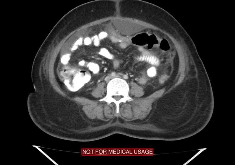 File:Amoebic enterocolitis with liver abscess (Radiopaedia 35100-36609 A 50).jpg