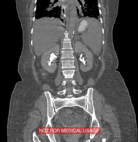 File:Amoebic enterocolitis with liver abscess (Radiopaedia 35100-36609 B 137).jpg