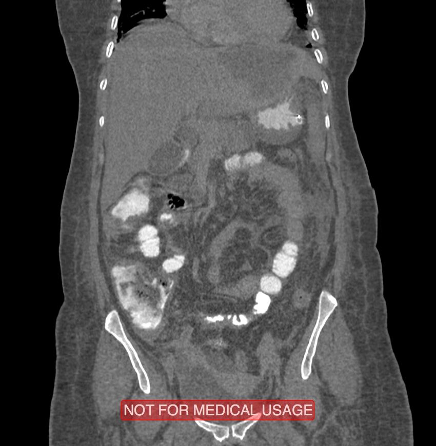 Amoebic enterocolitis with liver abscess (Radiopaedia 35100-36609 B 75).jpg