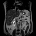Ampullary tumor (Radiopaedia 27294-27479 Coronal T2 13).jpg