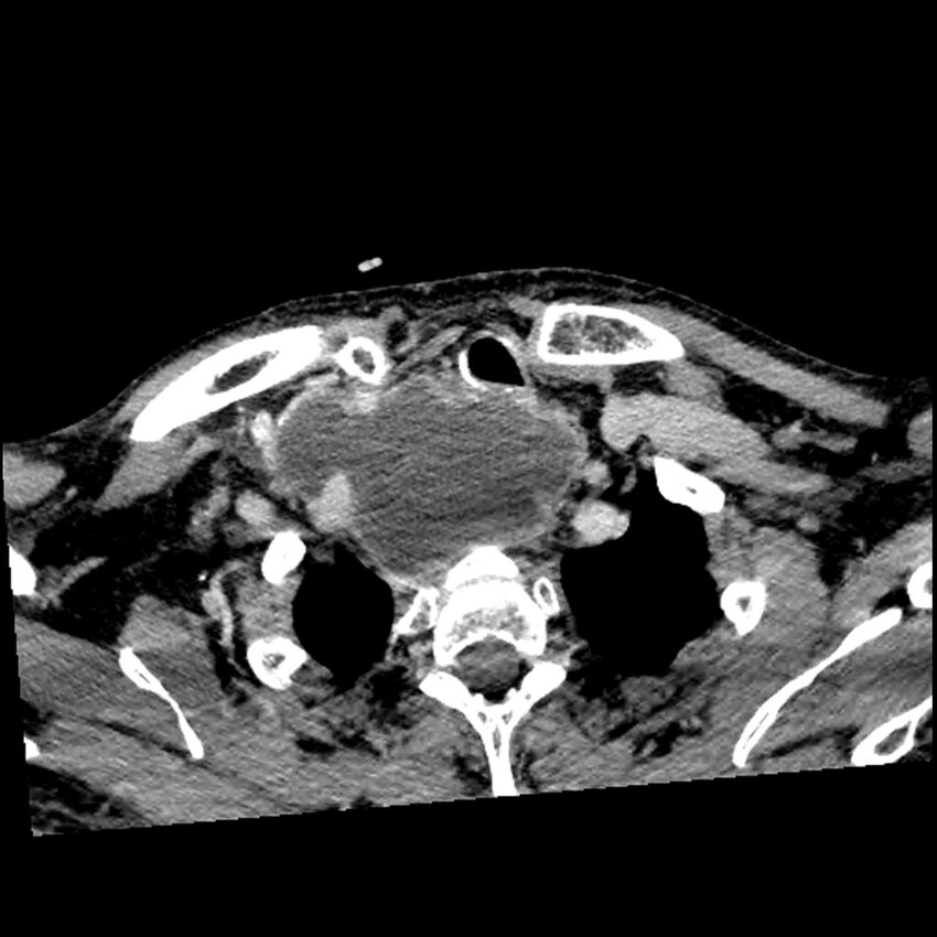 Anaplastic thyroid carcinoma (Radiopaedia 79087-92034 B 31).jpg
