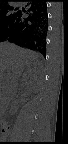 File:Aneurysmal bone cyst T11 (Radiopaedia 29294-29721 Sagittal bone window 69).jpg