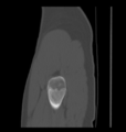 Aneurysmal bone cyst of ischium (Radiopaedia 25957-26094 Sagittal bone window 6).png